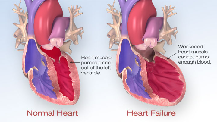 end-stage-heart-failure-treatment